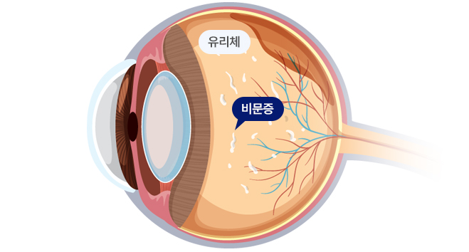 암슬러그리드 테스트