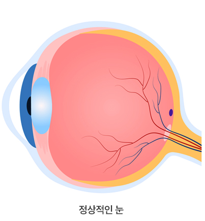 녹내장