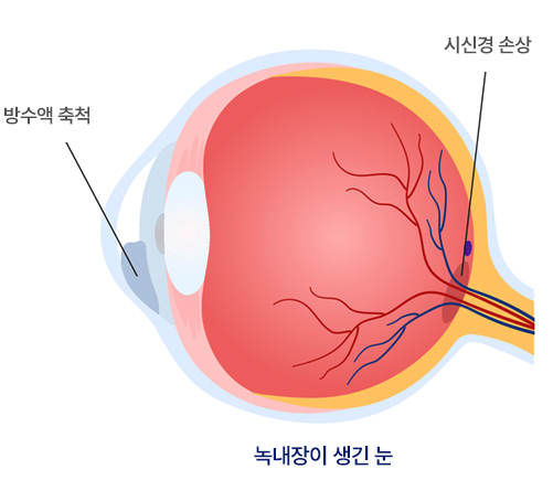 녹내장