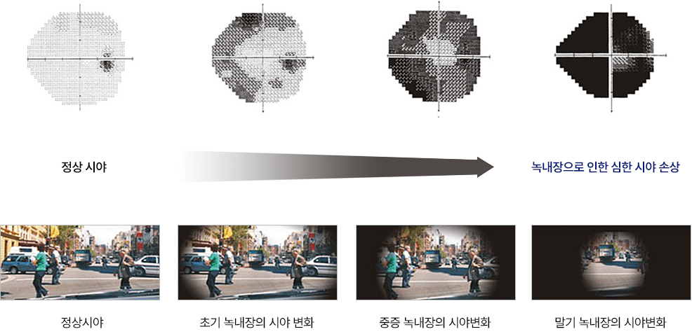 녹내장 진행에 따른 시야 손상의 증가
