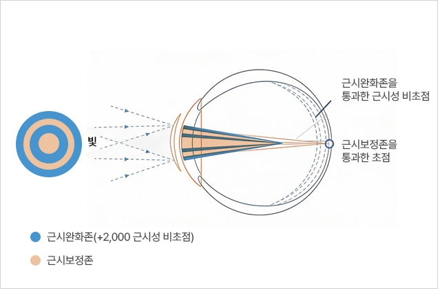 백내장