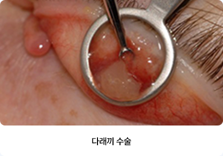 다래끼 치료